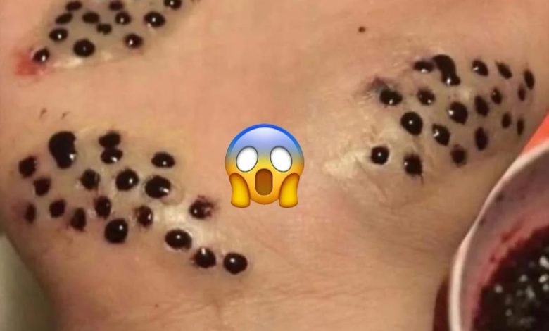 SKIN blackhead