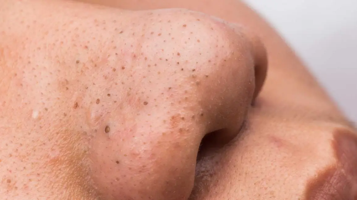 SKIN blackhead