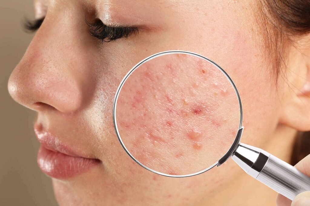 Do Cortisone Shots Work for Acne